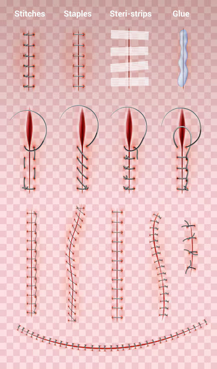 Sutures